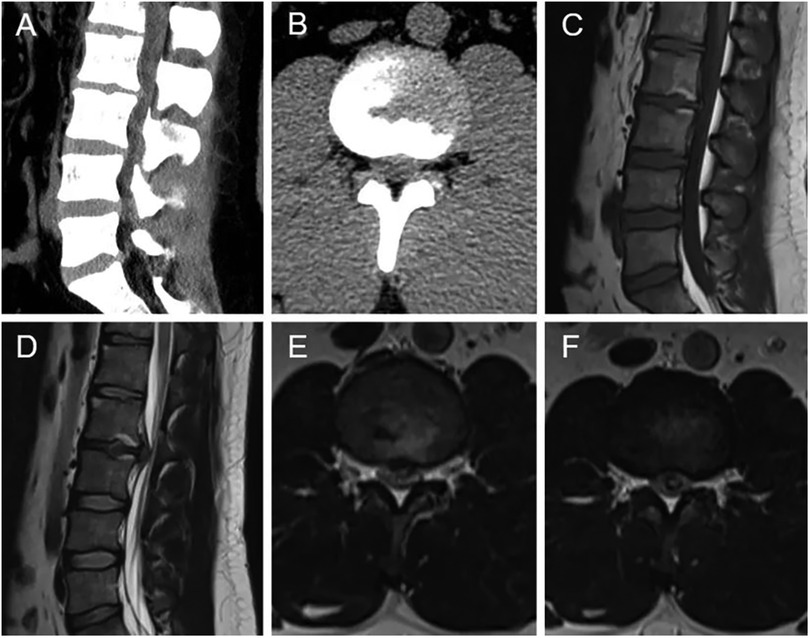 Frontiers  Intradural lumbar disc herniation of L2–L3: A case report and  literature review