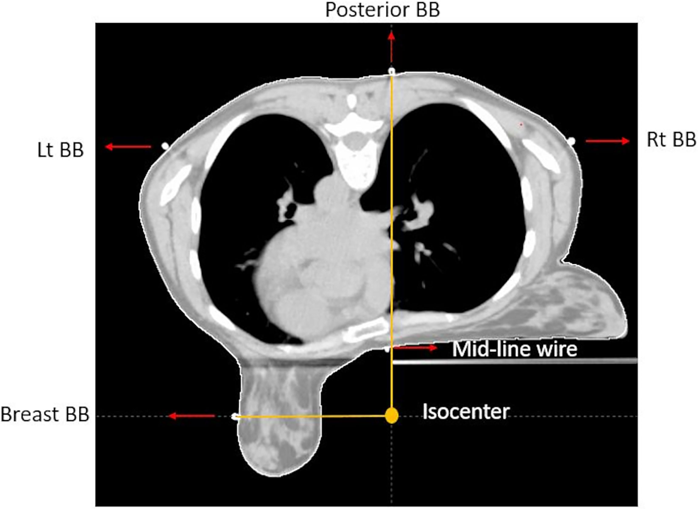 Frontiers  Accelerated partial breast irradiation in early stage breast  cancer