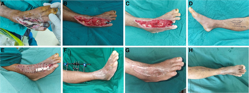 The outcomes of Ilizarov treatment in aseptic nonunions of the tibia  stratified by treatment strategies and surgical techniques