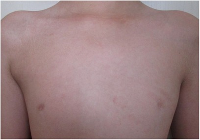 Lil Bone Peep on X: Poland syndrome: disorder w/ unilat missing/ underdeveloped muscles resulting in abnormalities. Affects pec major most  commonly, w/ assoc rib/nipple/breast abnormalities. Also can affect  shoulder, arm, & commonly the