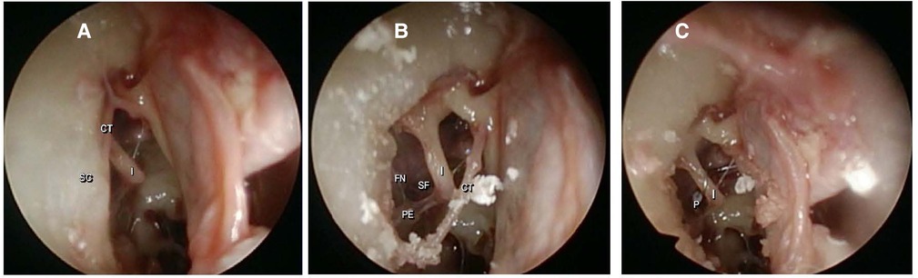 Artwork Of Prosthetic Stapes In Middle Ear Photograph by John