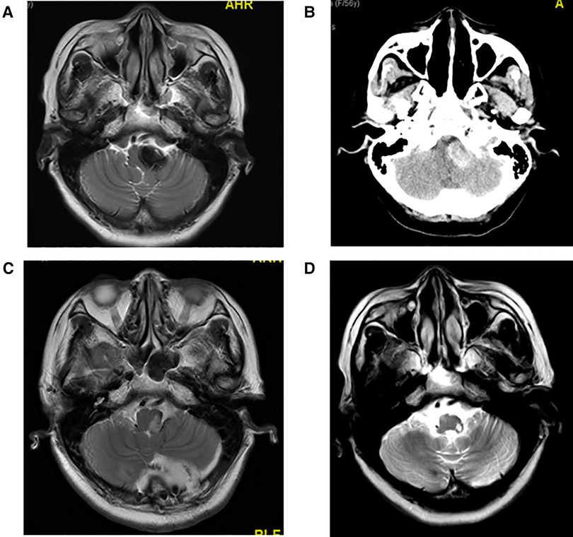 The Advances of Endoscopic Skull Base Tumor Surgery: from