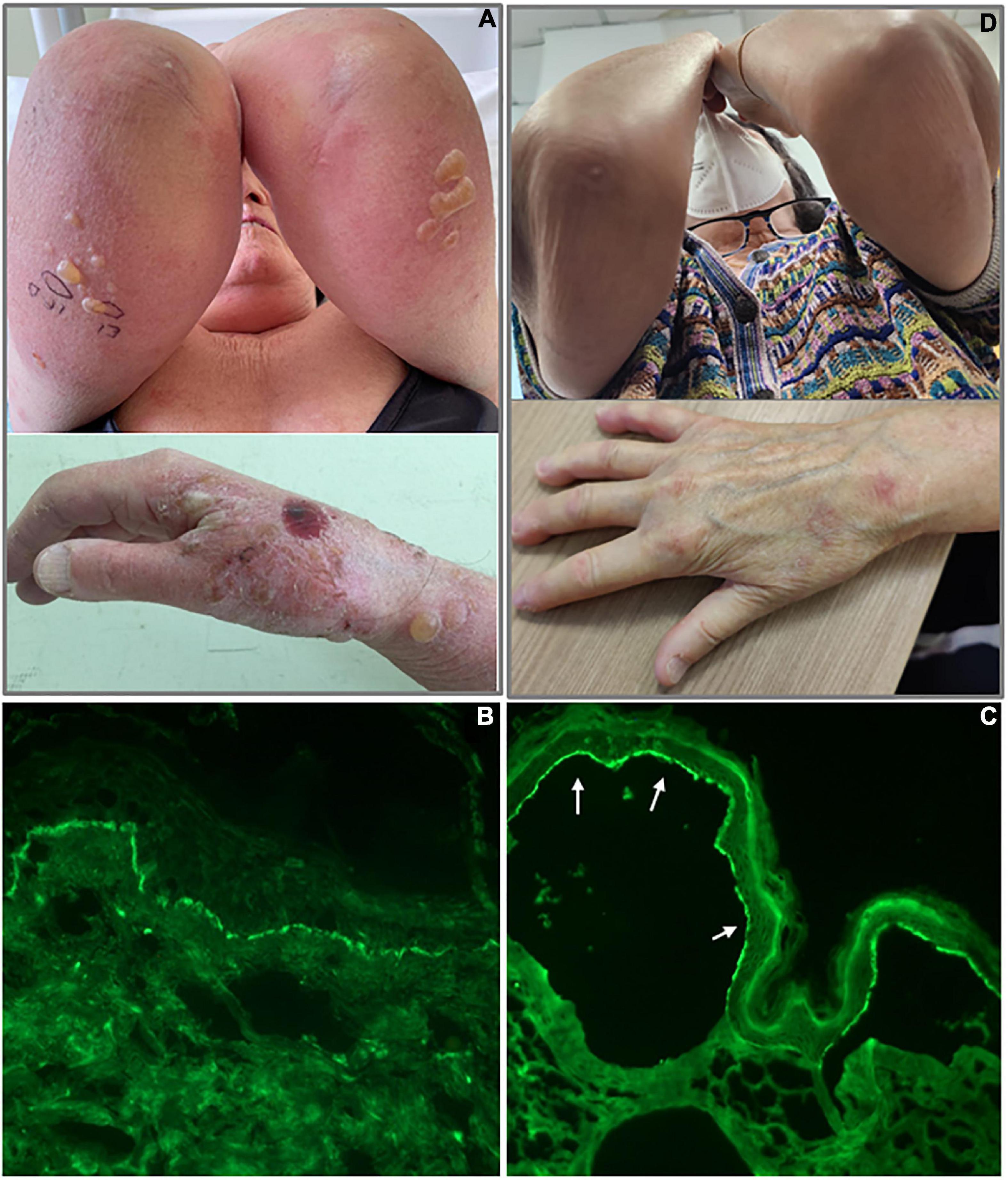 Frontiers  Case report: Bullous pemphigoid arising in a patient with  scleroderma and multiple sclerosis