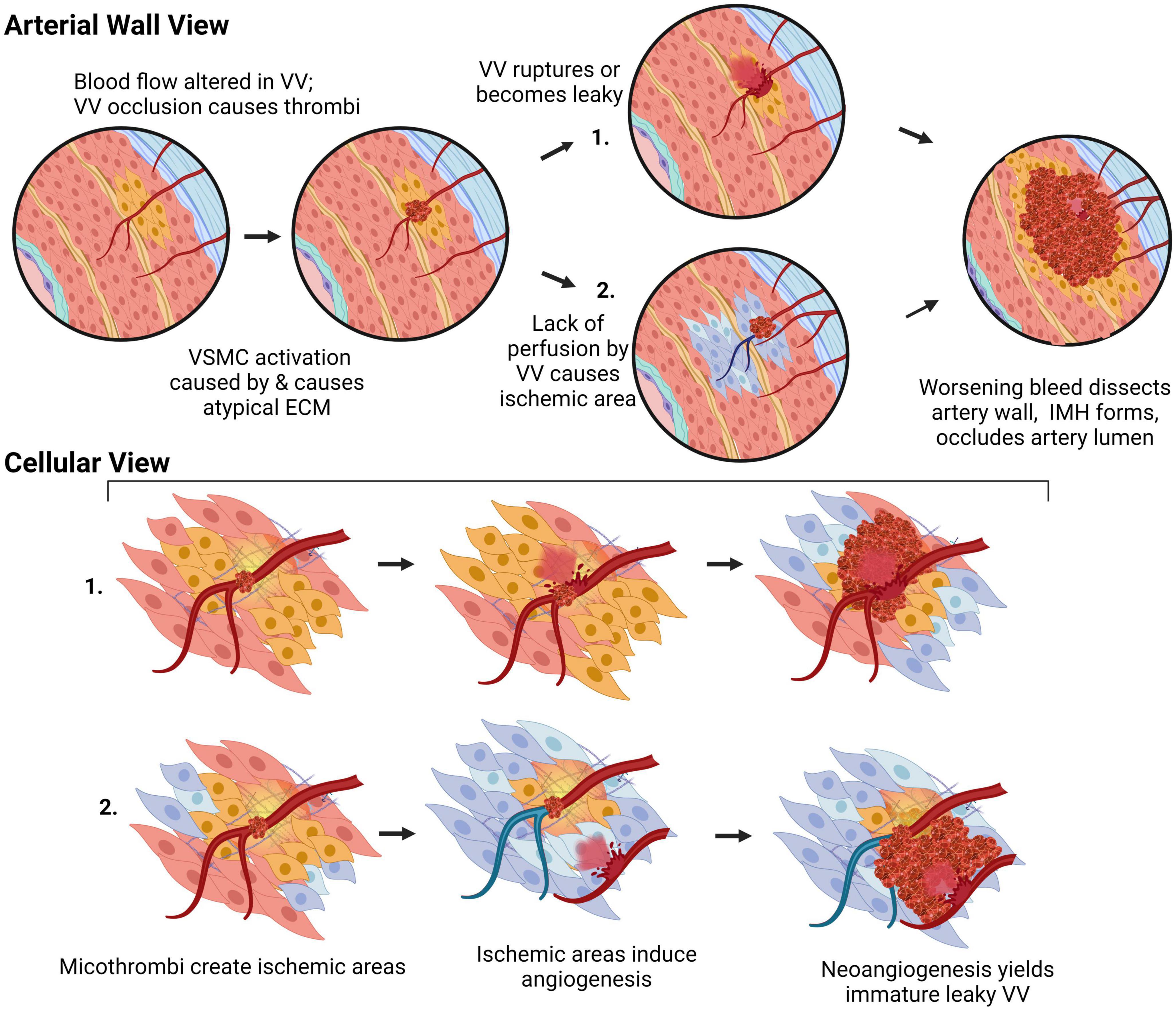 Increased Collagen Turnover Is a Feature of Fibromuscular