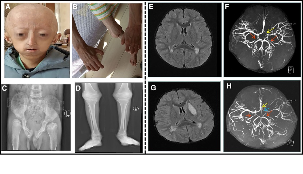 Frontiers Hutchinson Gilford Progeria Syndrome Complicated With