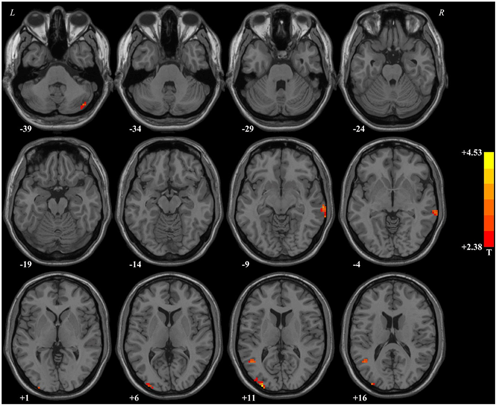 Frontiers  Neural activity in adults with major depressive disorder  differs from that in healthy individuals: A resting-state functional  magnetic resonance imaging study