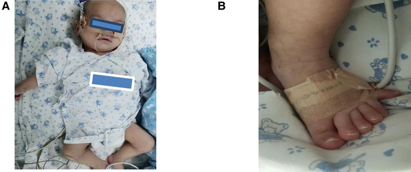 Frontiers  Case report: A preterm infant with rubinstein-taybi