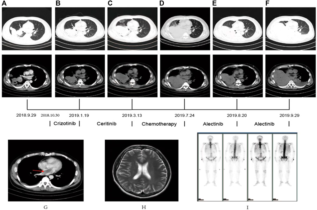 Frontiers | Primary resistance to first- and second-generation ALK ...