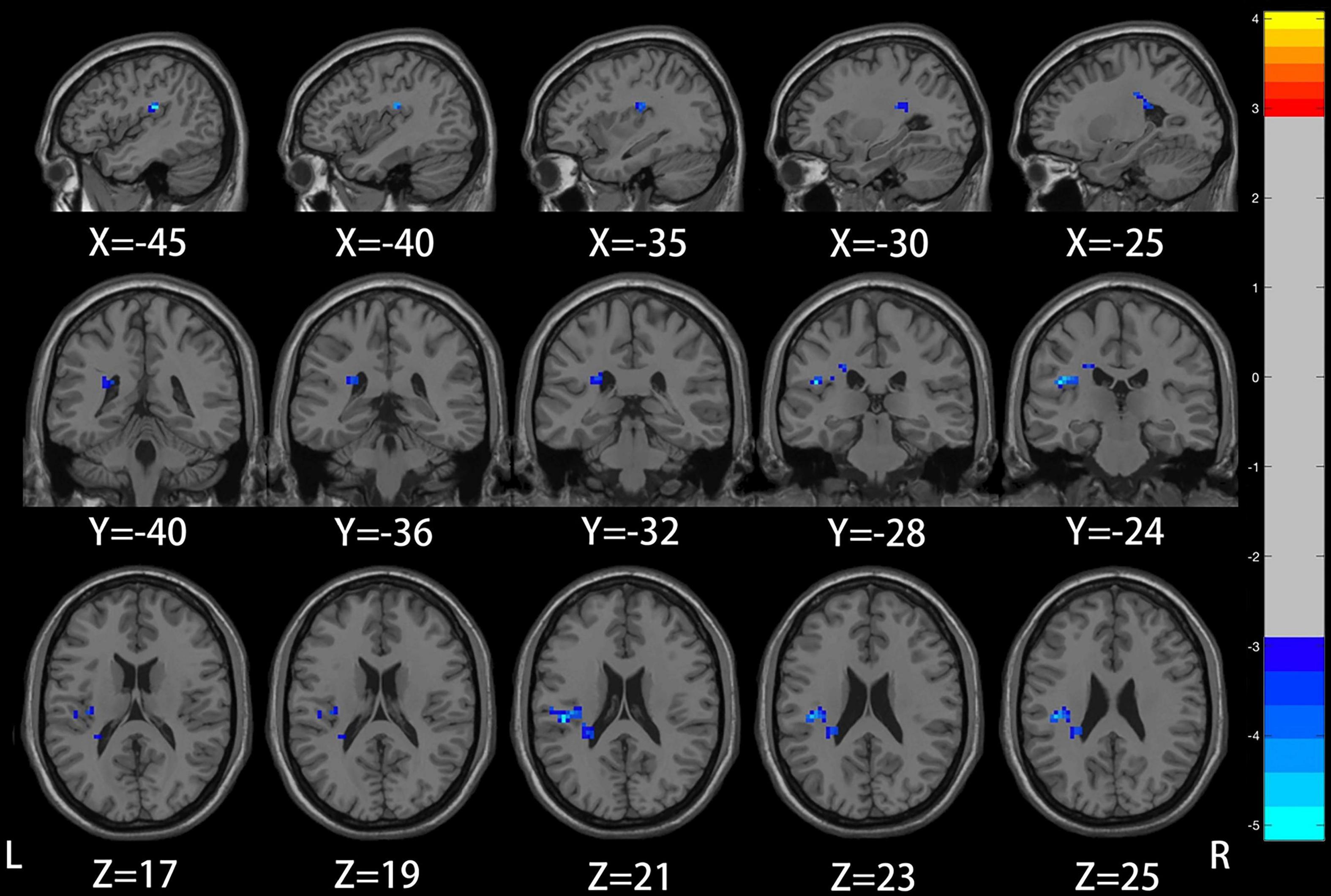 Frontiers  Neural activity in adults with major depressive disorder  differs from that in healthy individuals: A resting-state functional  magnetic resonance imaging study