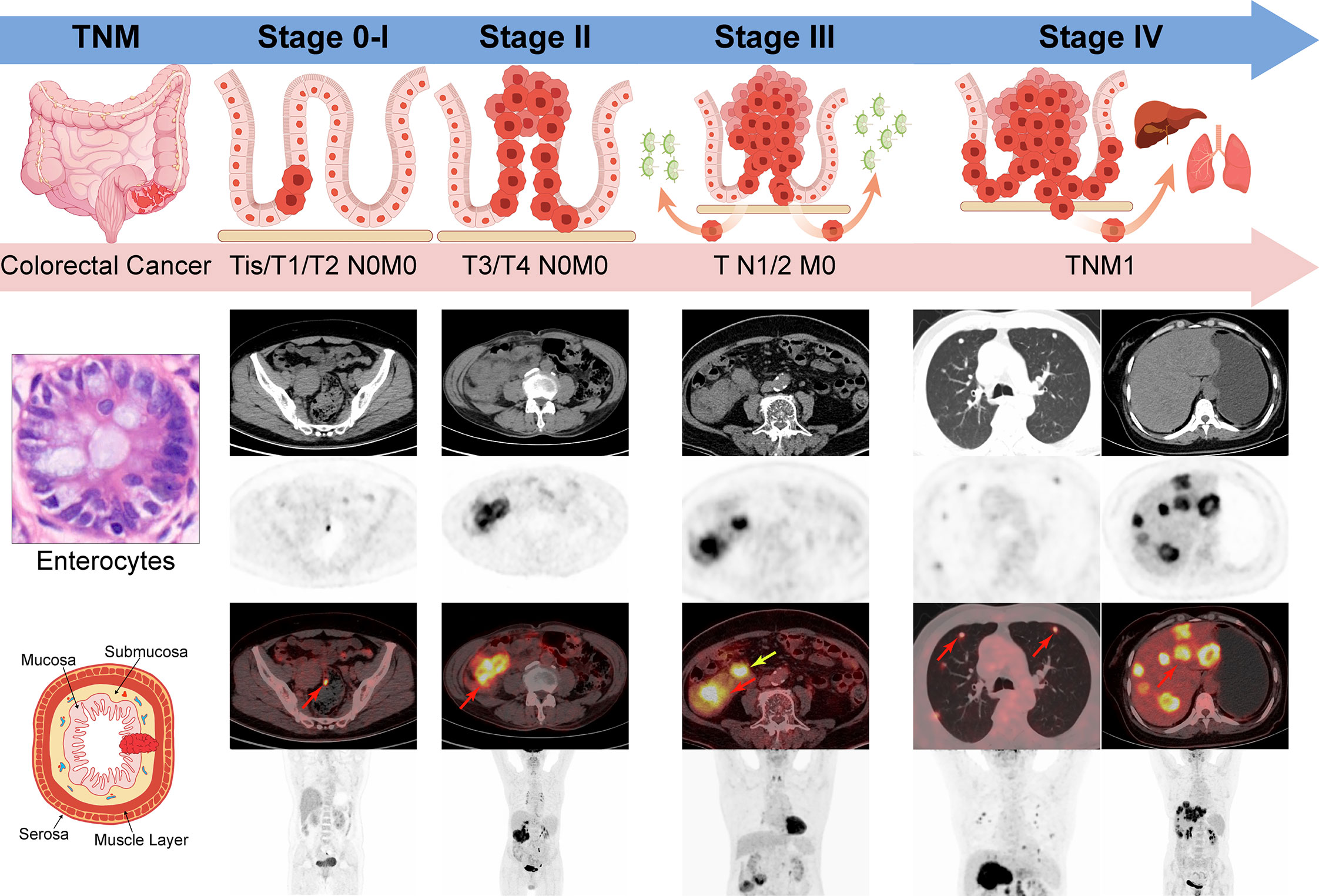 colon cancer stage 0