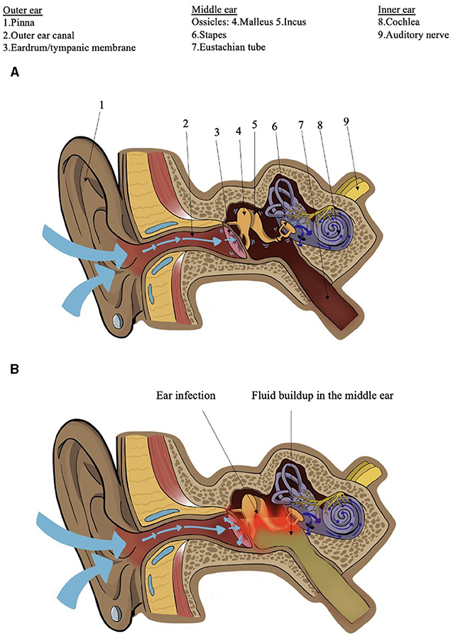 Figure 1 - (A) Diagram of the ear, showing sound waves (blue arrows) bouncing off the pinna and traveling through the outer ear canal, through the middle ear via the vibration of the ossicles, and through the cochlea of the inner ear to the auditory nerve.