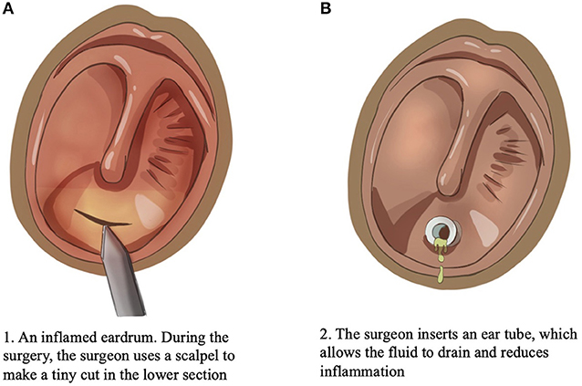 Figure 3 - (A) In a surgery called a tympanostomy, a surgeon uses a small scalpel to make an incision in the lower section of the inflamed eardrum.
