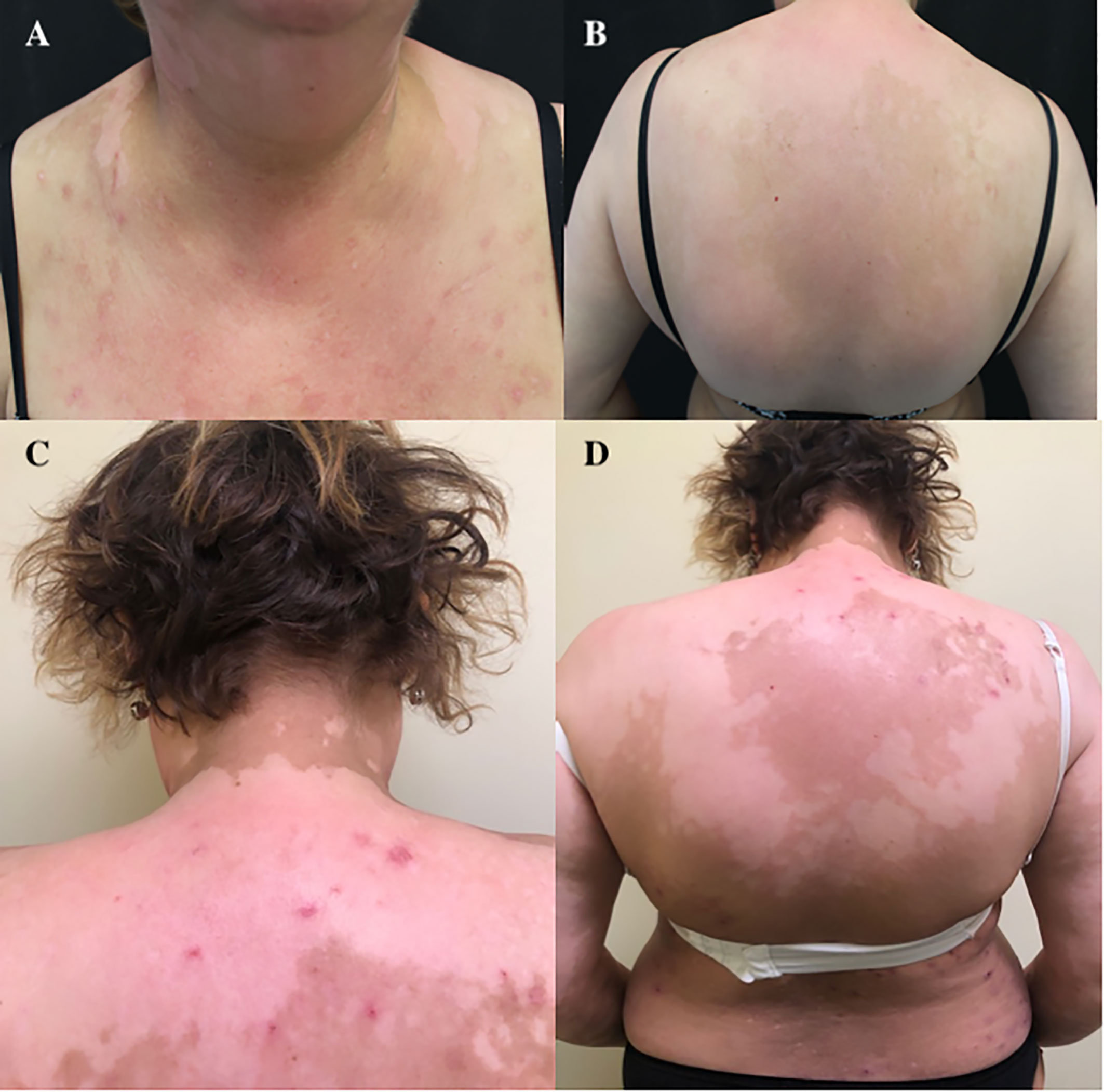 Acne in between breast – Back/Body/Neck acne –  Forum