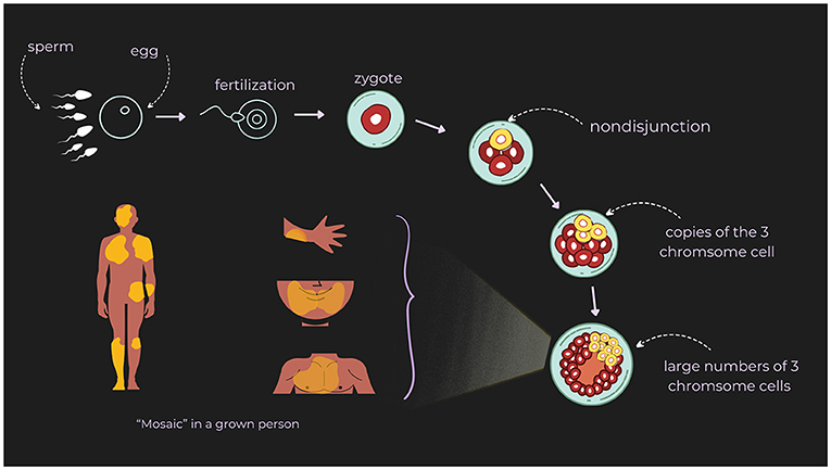 Figure 1 - Mosaic down syndrome.