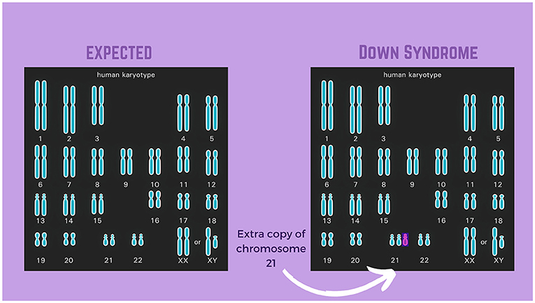 Figure 2 - Down syndrome due to nondisjunction during meiosis or mitosis.