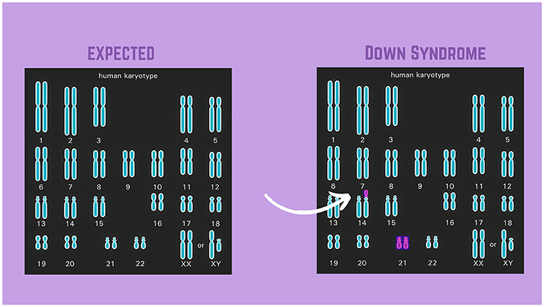 Figure 3 - Down syndrome due to translocation.