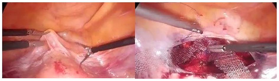 Frontiers  Postoperative results of laparoscopic lateral suspension  operation: A clinical trials study