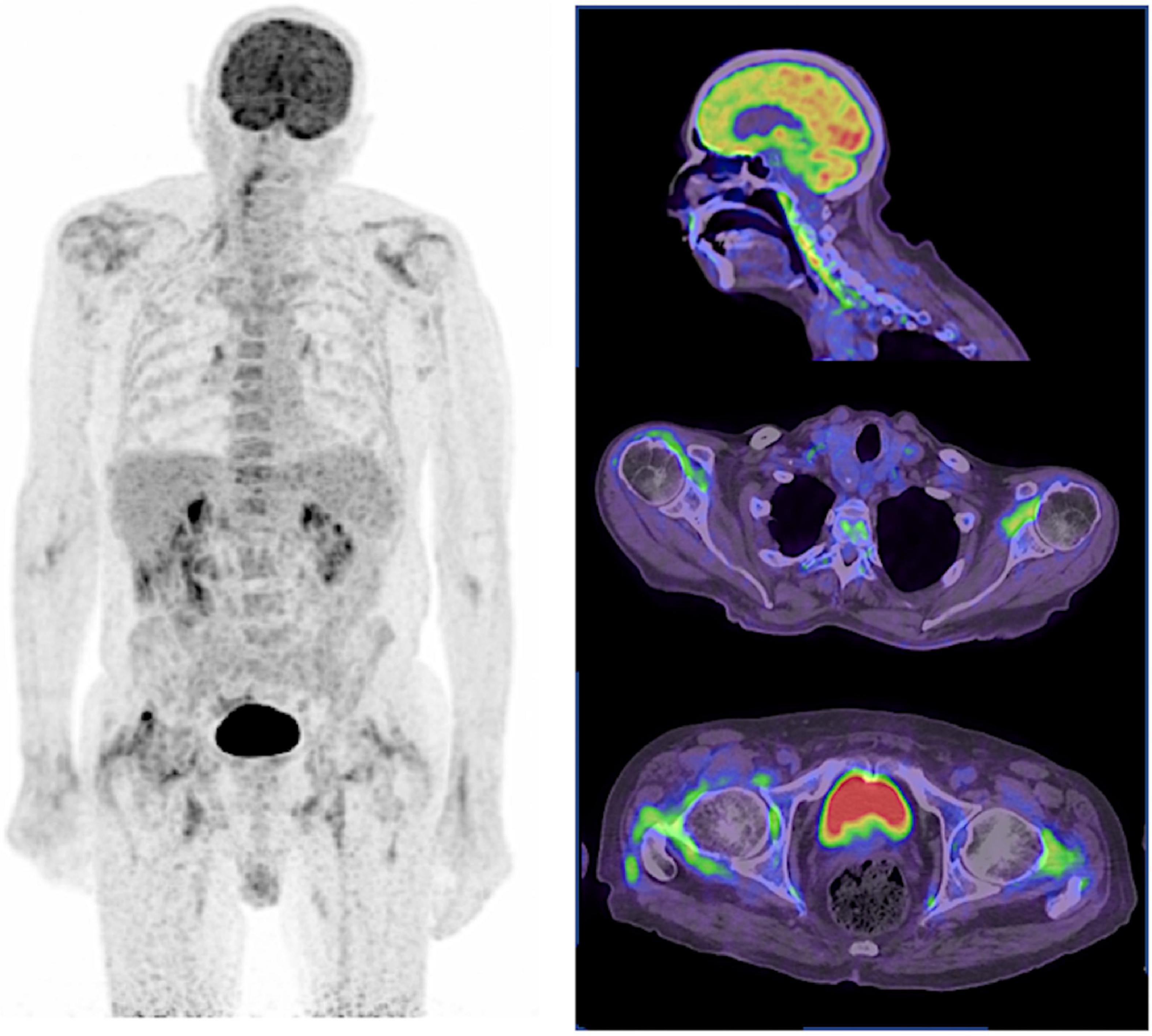 Frontiers 18F FDG PET Molecular Imaging A Relevant Tool To 