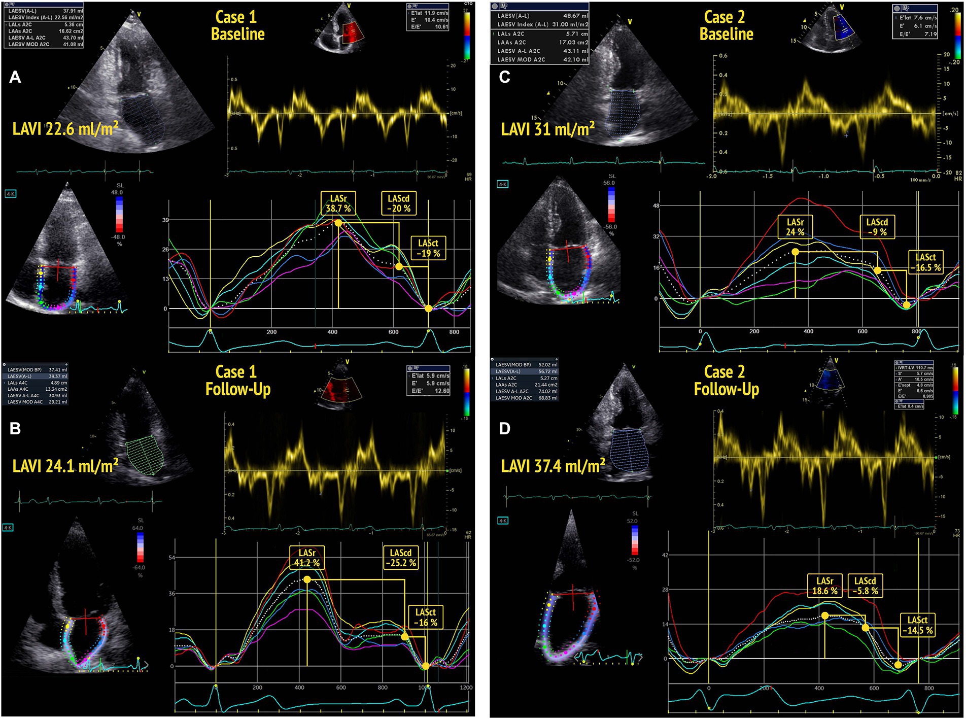 4.5 A Simple Approach to Diastolic Dysfunction