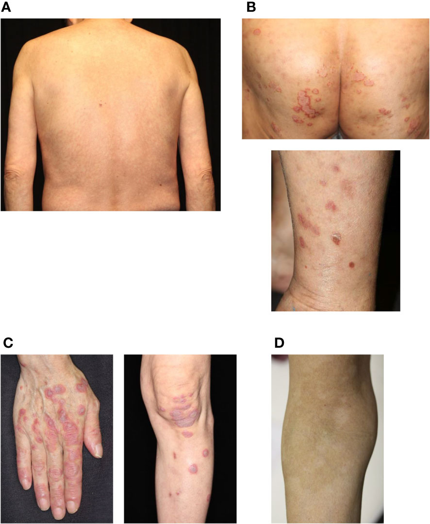 Immune Regulations of Inflammatory Skin Diseases | Frontiers