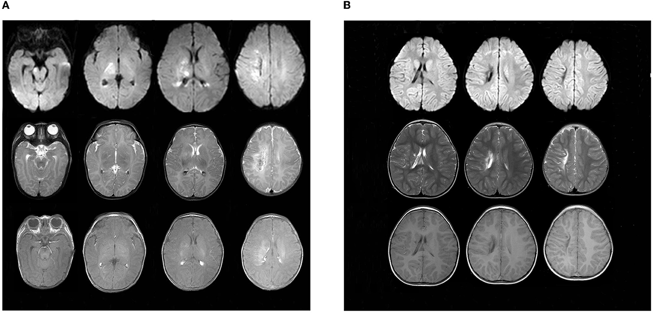 Frontiers  Case report: A 10-year prognosis of neonatal diabetes