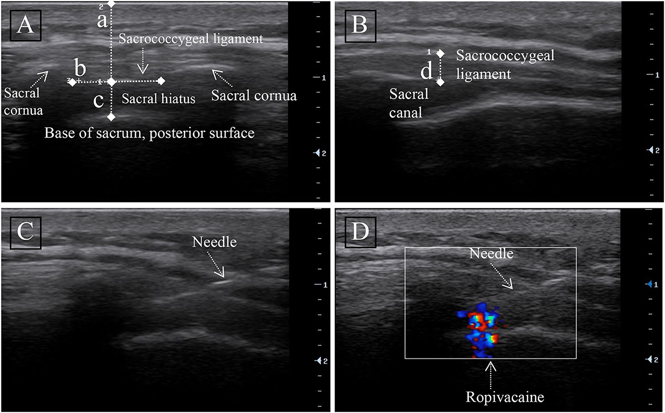 PDF) Comparison of the spread of injectate after ultrasound-guided