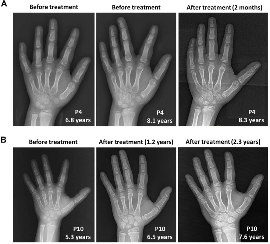 Expanding the phenotype associated to KMT2A variants: overlapping clinical  signs between Wiedemann–Steiner and Rubinstein–Taybi syndromes