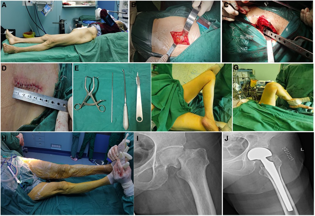 A minimally invasive surgical approach for the treatment of piriformis  syndrome: a case series, Chinese Neurosurgical Journal