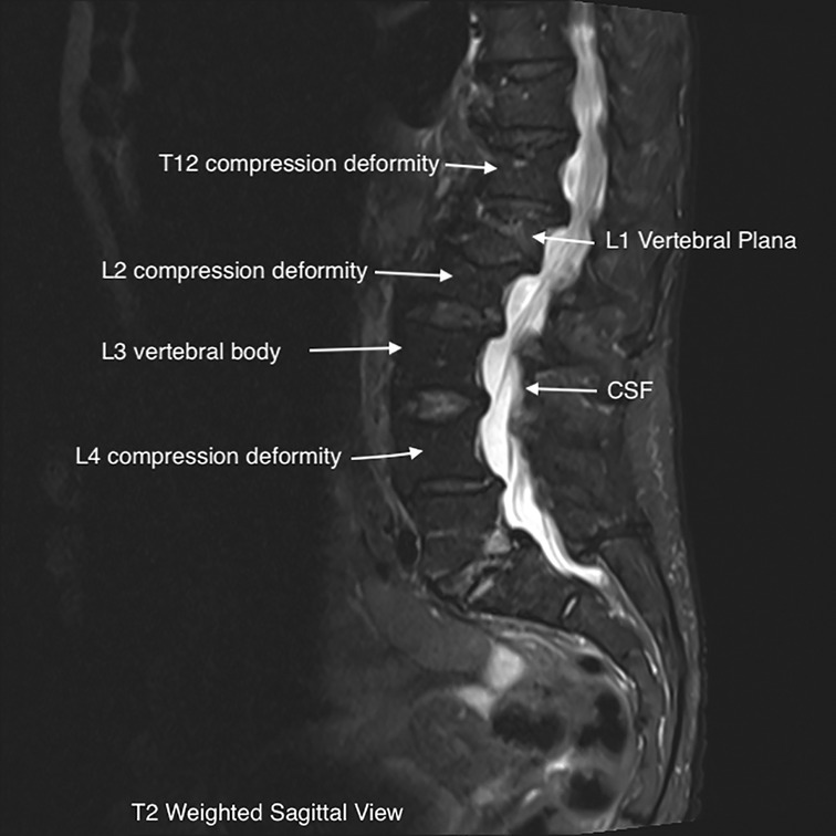 Frontiers  Case report: Use of peripheral nerve stimulation for