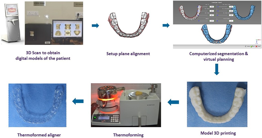 American Academy of Clear Aligners - Some Clear Aligner Systems utilize  attachments as part of the protocol and some do not. When a system (such as  Invisalign) uses attachments, are they truly