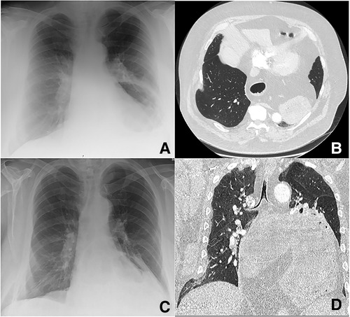 Muscle hernia in a 40-year-old man with a tender palpable mass at