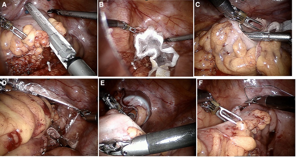 Frontiers  Comparison of transabdominal wall specimen retrieval