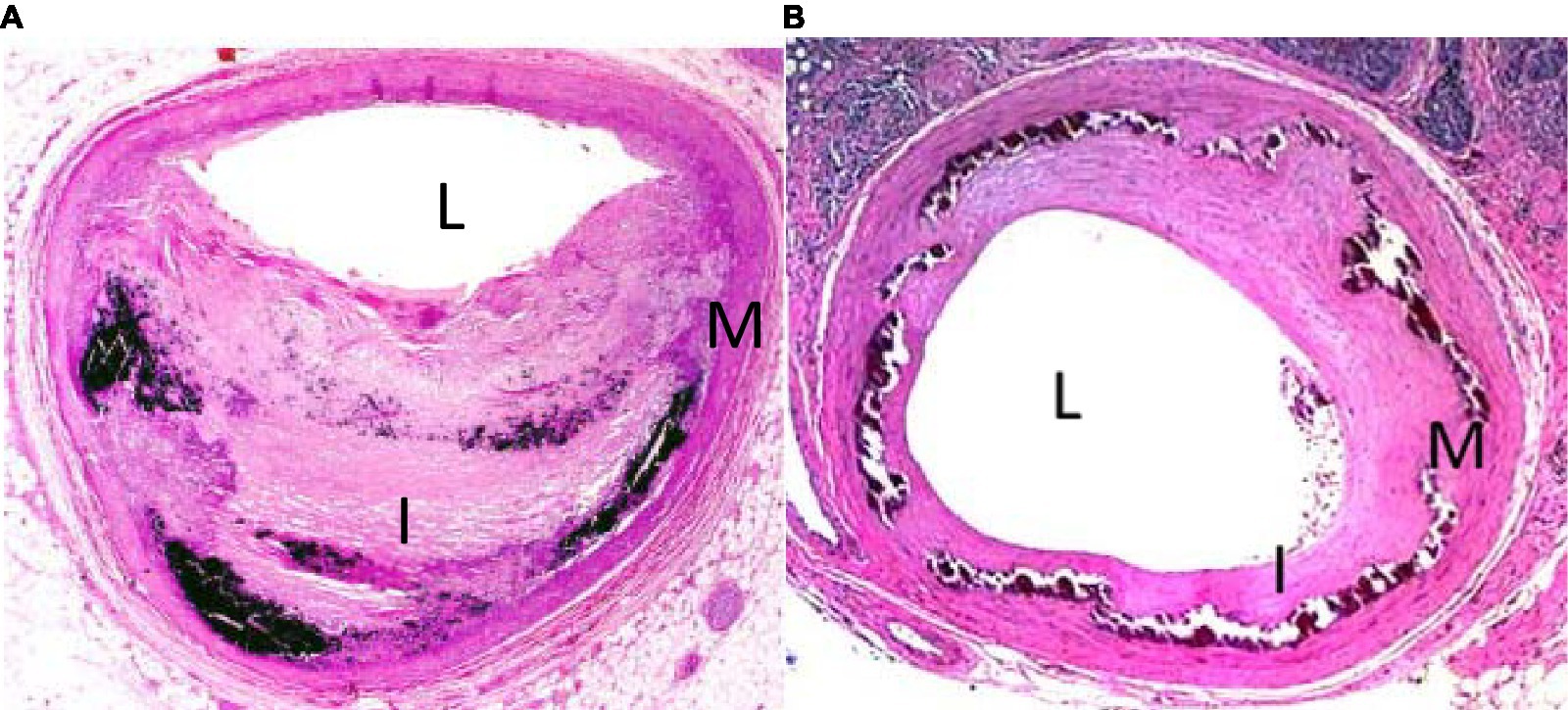 Frontiers Medial Artery Calcification In Peripheral Artery Disease