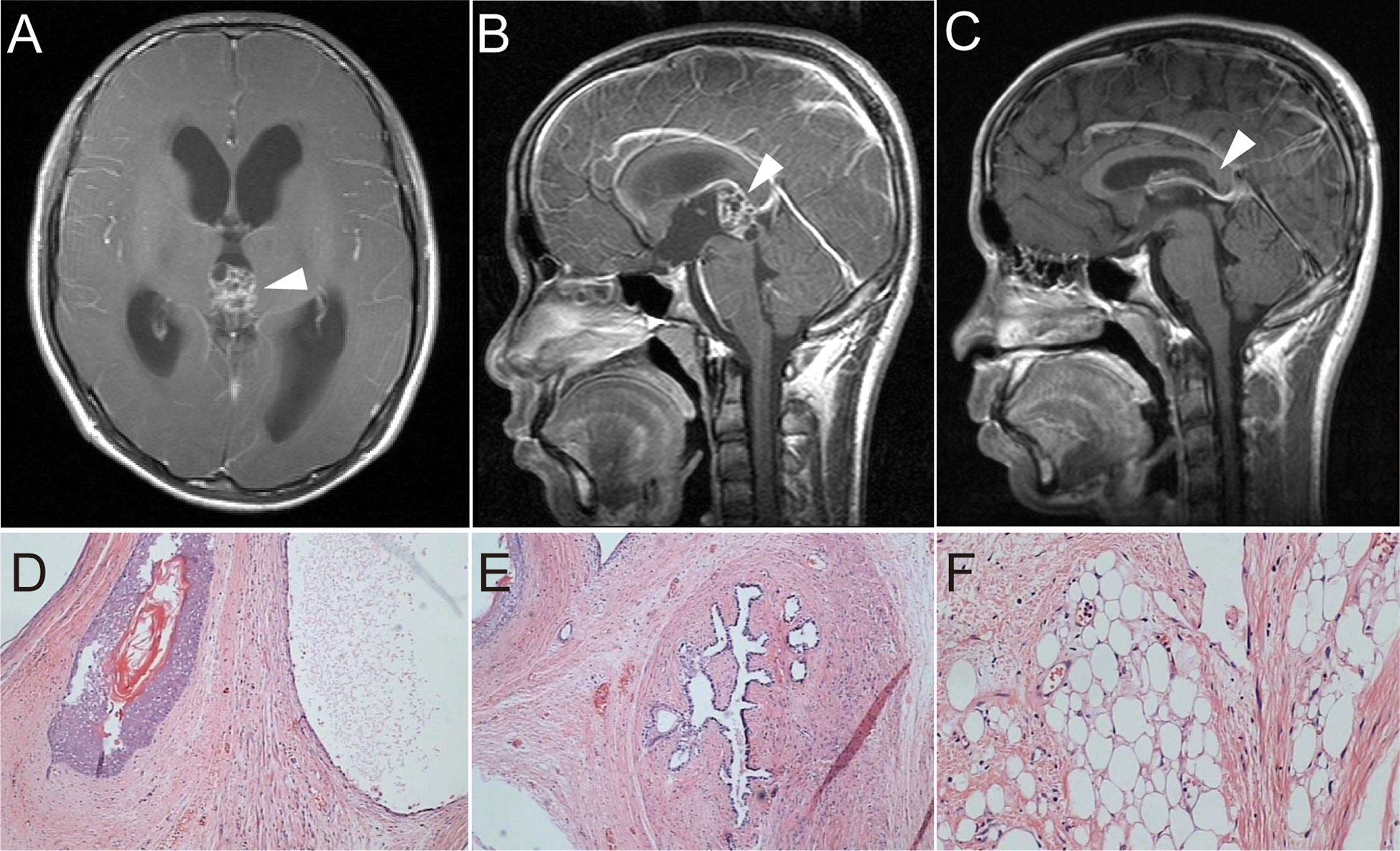 Frontiers  Multiple ectopic recurrent germ cell tumors after