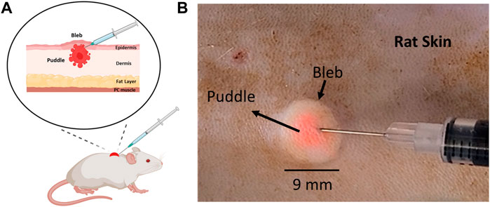 intradermal injection