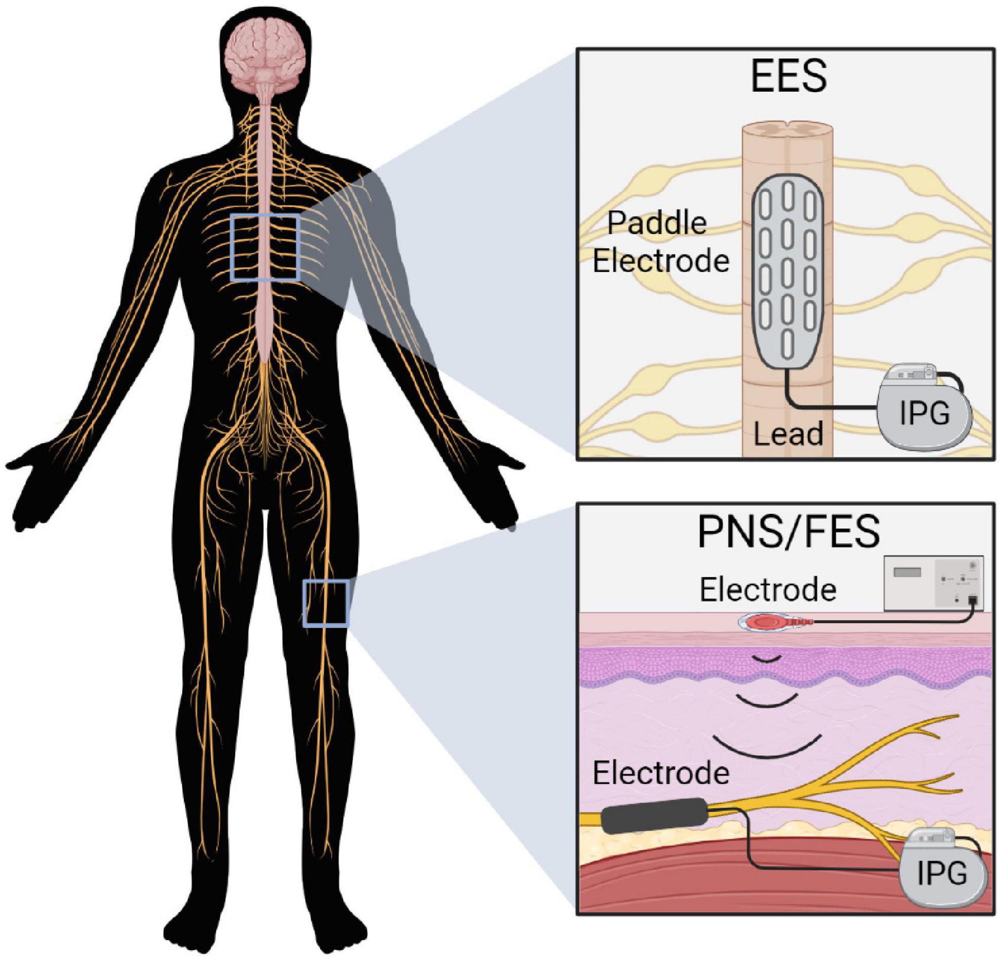 Utilizing a Double Epidural Electrical Stimulation Implant For SCI