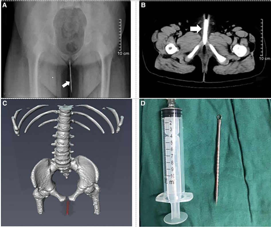 Frontiers | Foreign bodies in children's lower urinary tract: A case ...