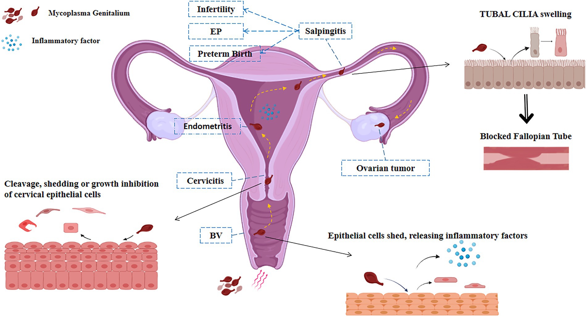 Frontiers Mycoplasma genitalium infection in the female reproductive system Diseases and treatment image