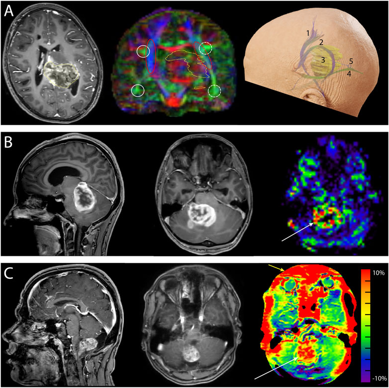 Frontiers  Multiparametric magnetic resonance imaging-derived