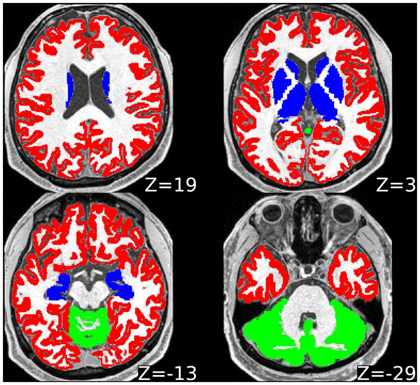 Frontiers  Multiparametric magnetic resonance imaging-derived