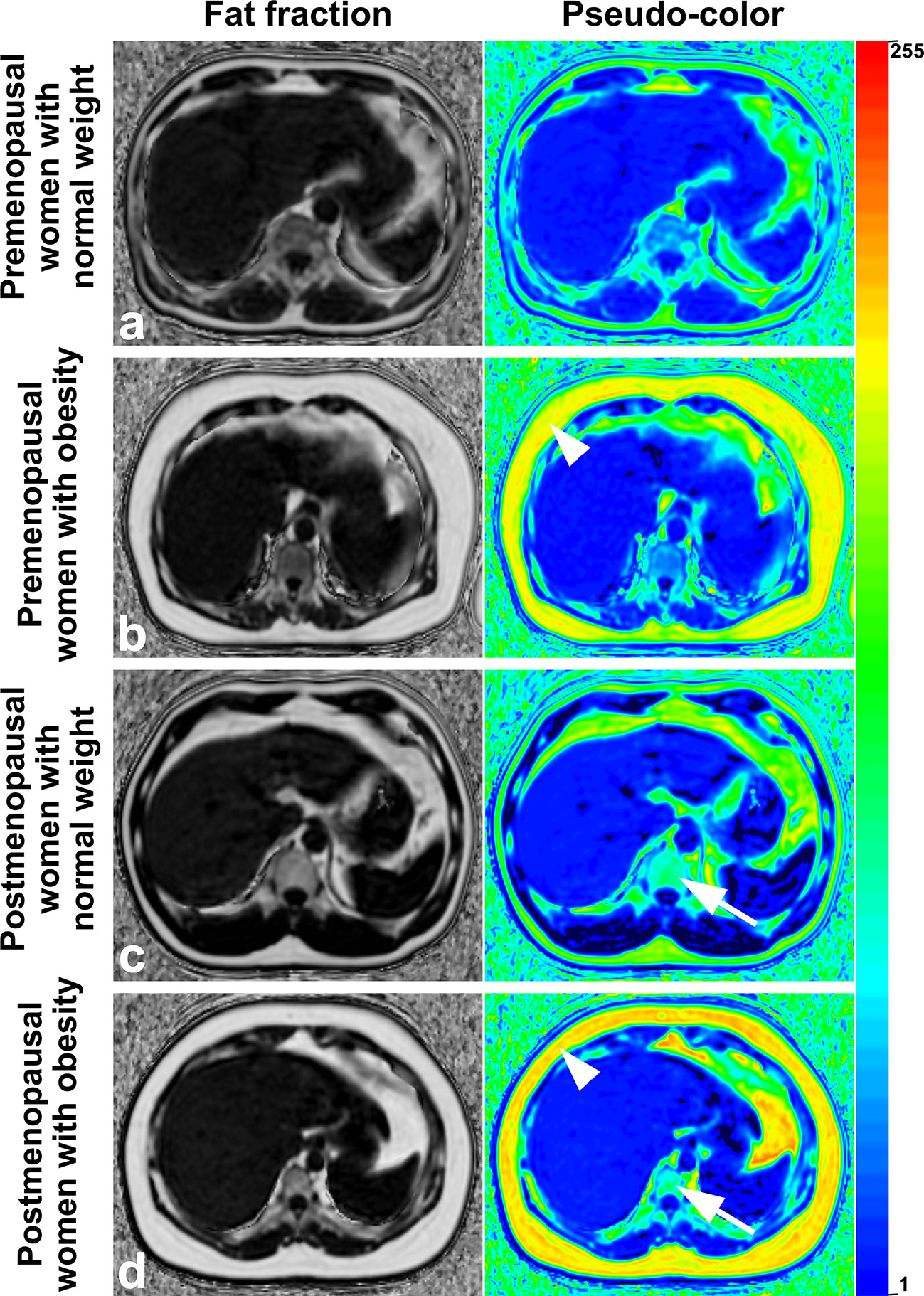 Quantification of Breast Volume According to age and BMI: A  Three-Dimensional MRI Analysis of 400 Women