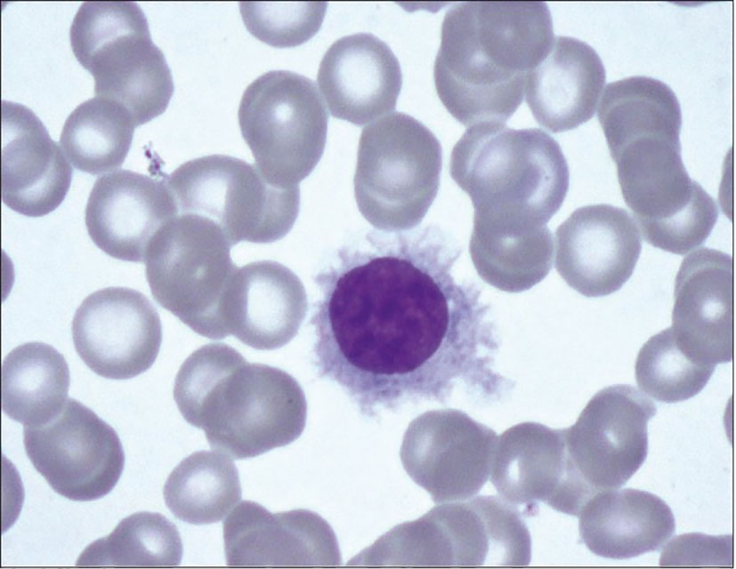 Frontiers | Case report: A case of classic hairy cell leukemia with CNS  involvement treated with vemurafenib