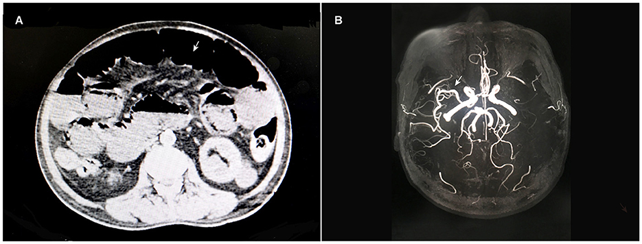 Frontiers  Ultrasound-guided transversus abdominis plane block as