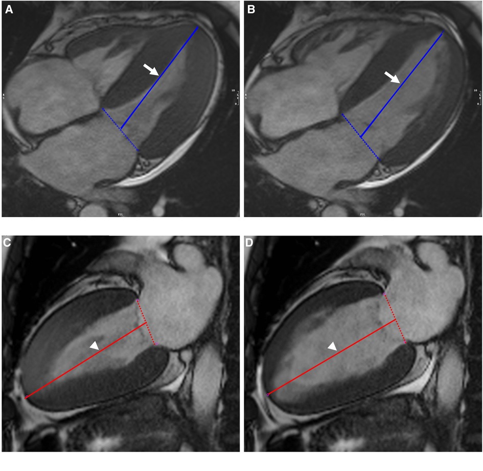 Echocardiography and cardiovascular magnetic resonance based evaluation of myocardial  strain and relationship with late gadolinium enhancement, Journal of  Cardiovascular Magnetic Resonance