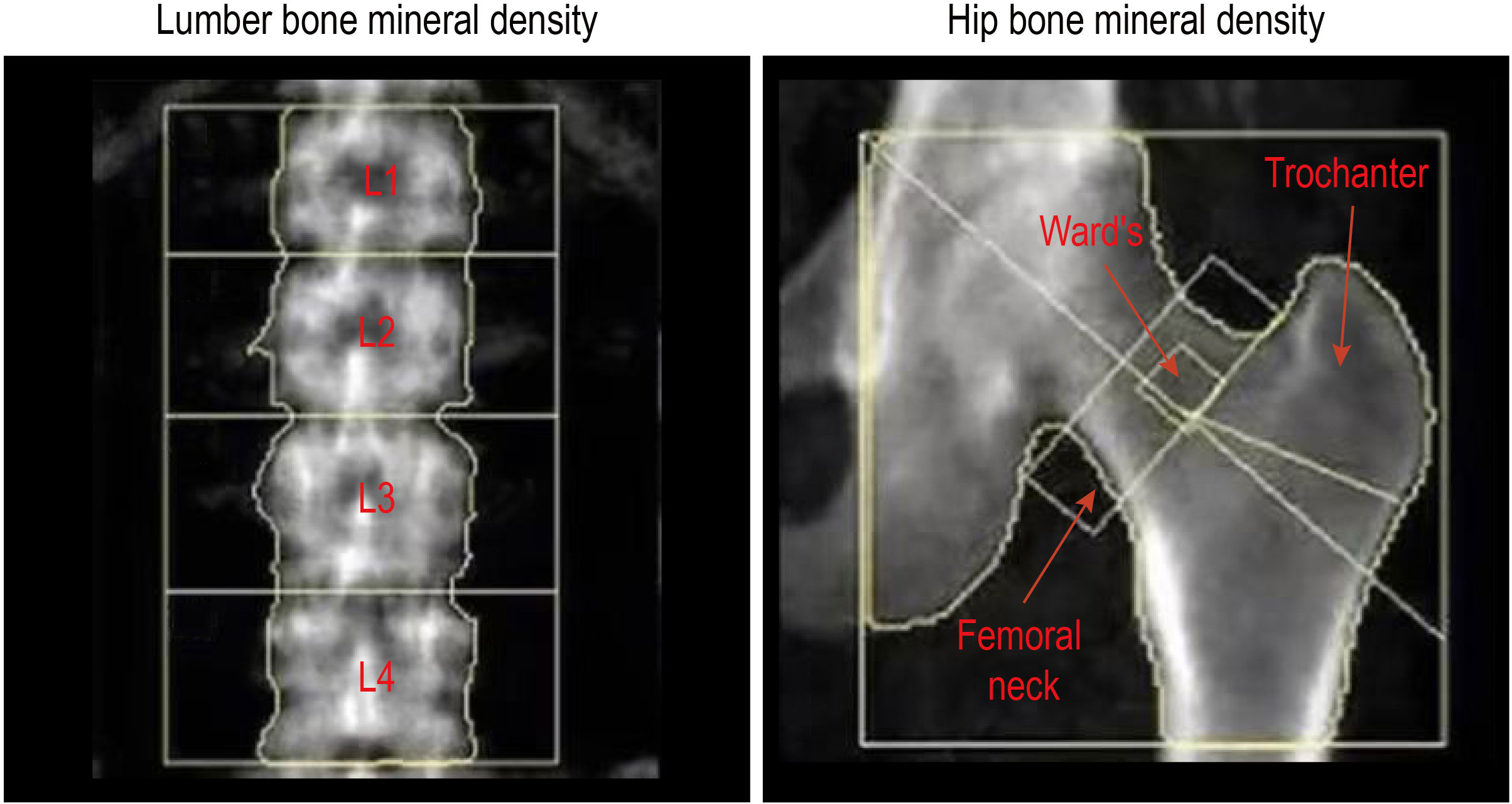 How Do DEXA Scans Work? The Science Behind Bone Mineral Density Tests