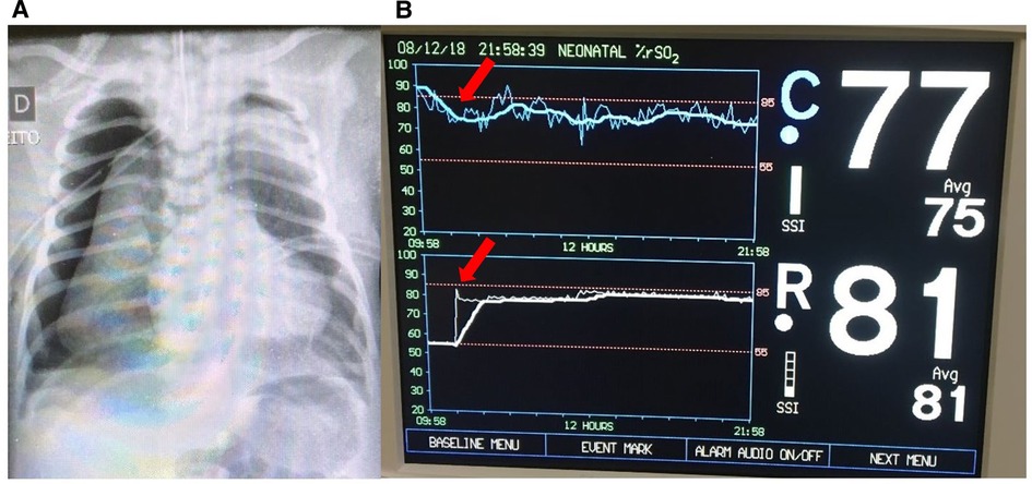 Navigating Neonatal Heart Rate Monitor Use in the Delivery Room