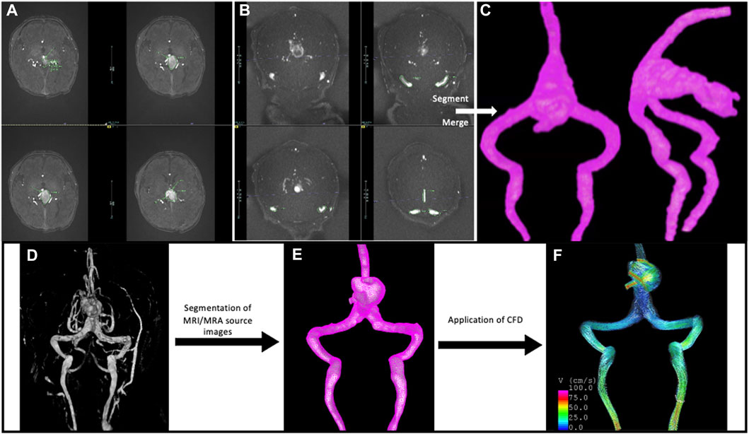 Frontiers | Understanding development of jugular bulb stenosis in vein ...