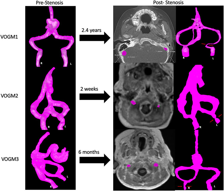 Frontiers | Understanding development of jugular bulb stenosis in vein ...