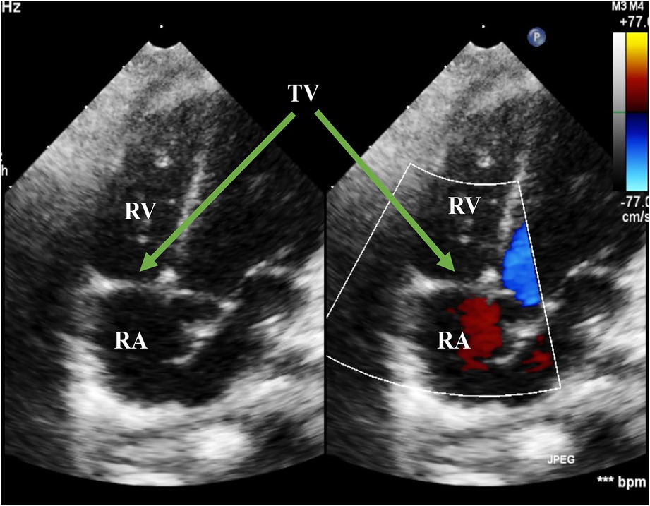 Frontiers | Diagnosis and intervention of severe tricuspid ...