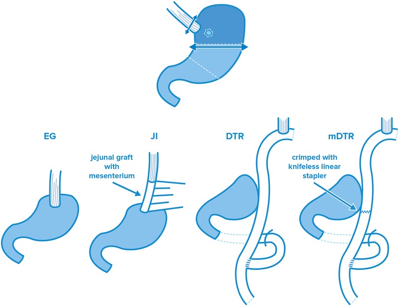 Types of Gastrectomy